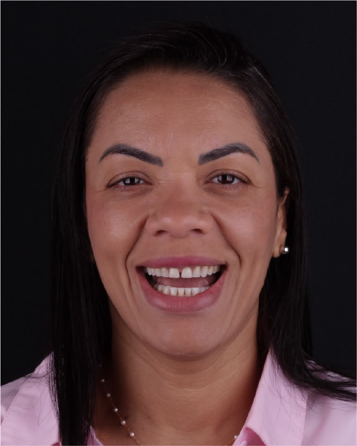 Sorriso antes do tratamento odontológico