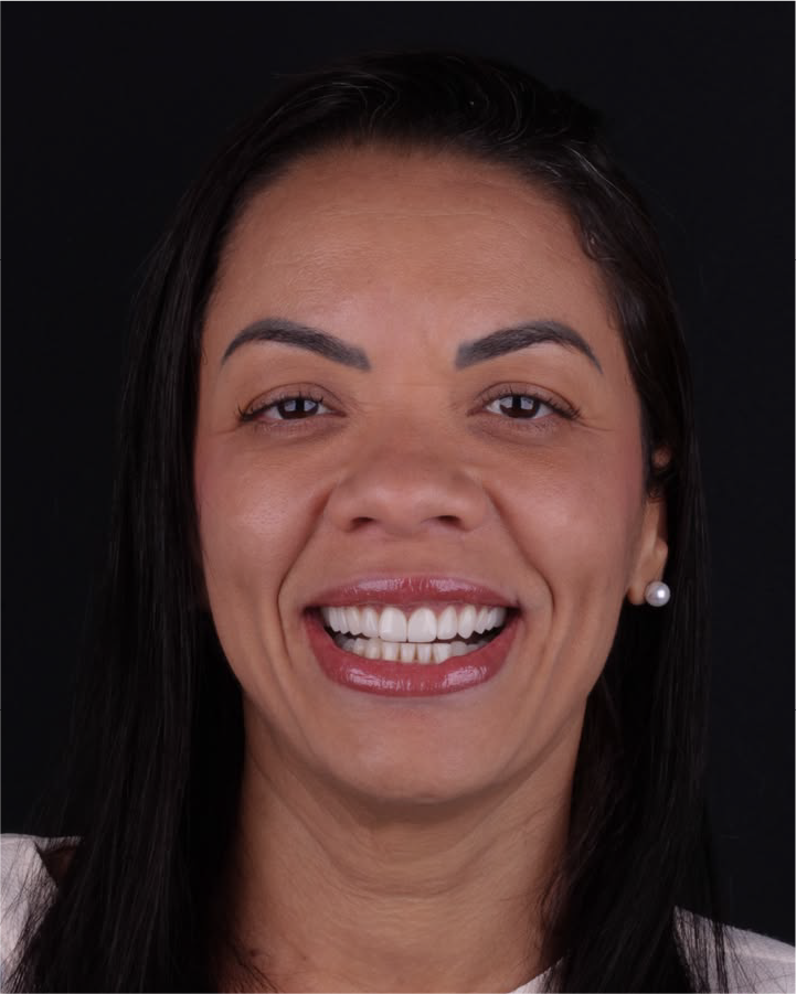 Sorriso depois do tratamento odontológico