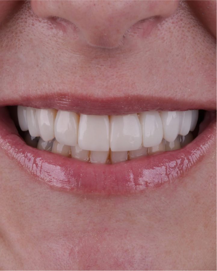 Sorriso depois do tratamento odontológico