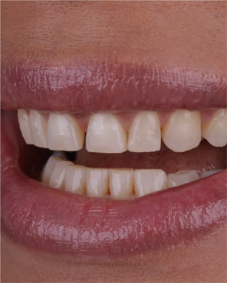 Sorriso antes do tratamento odontológico