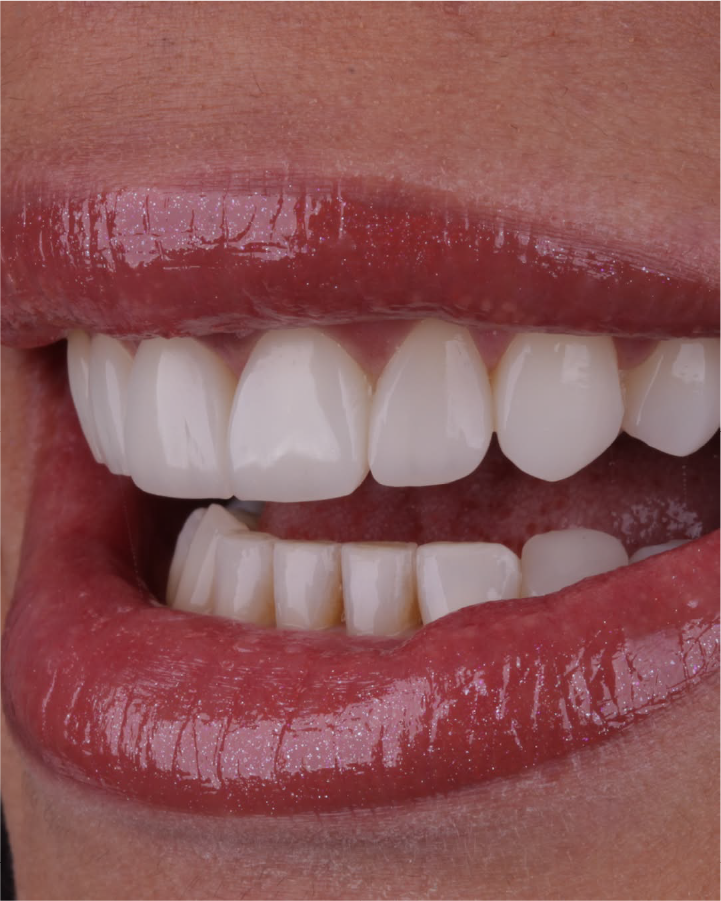 Sorriso depois do tratamento odontológico