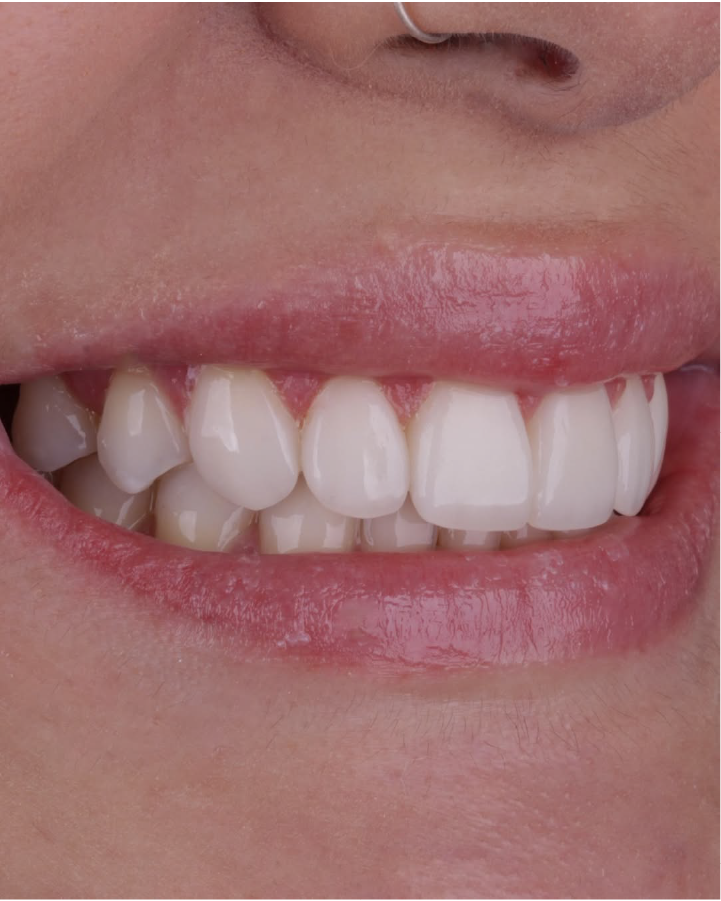 Sorriso depois do tratamento odontológico